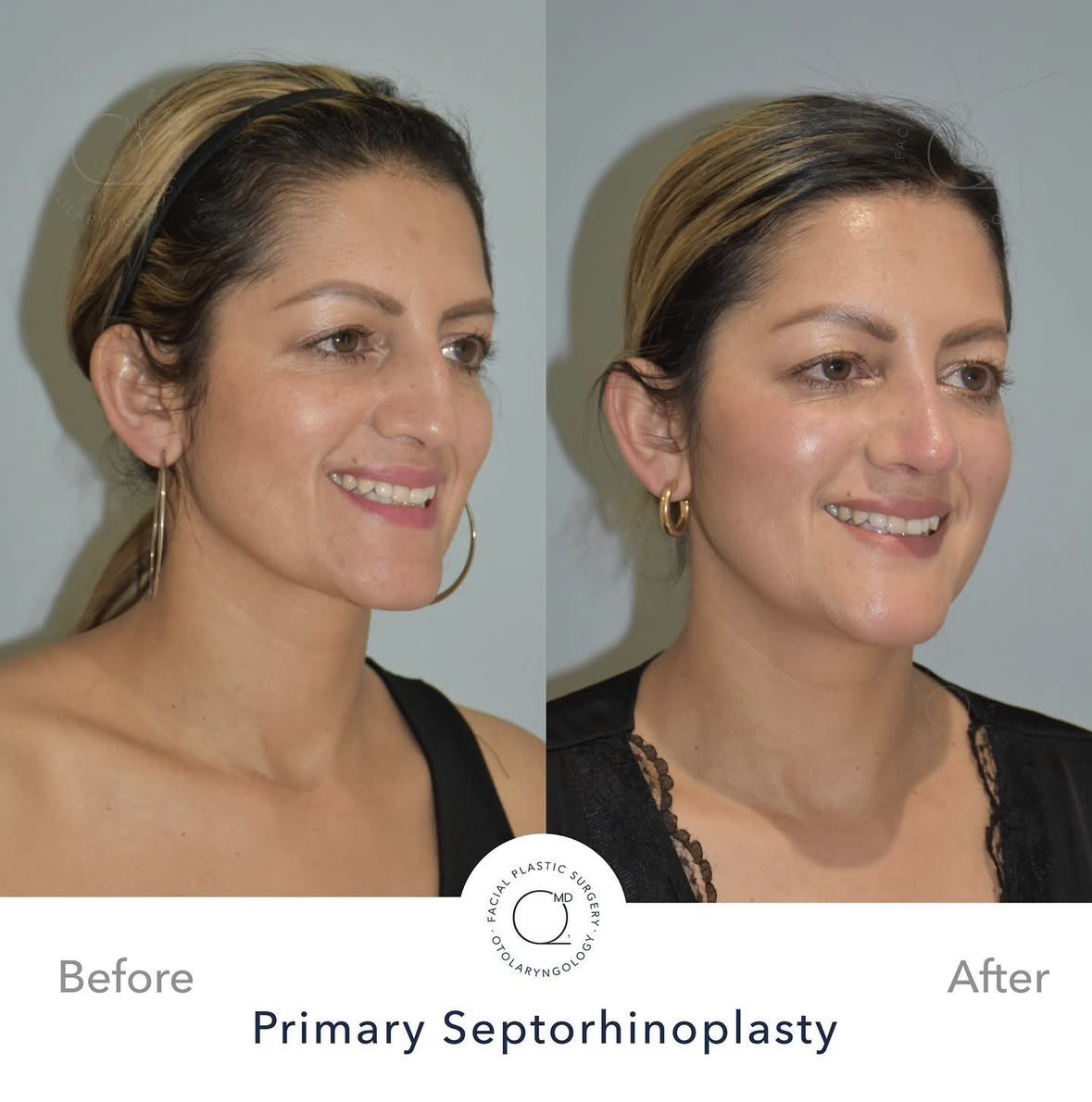 Rinoplastia Madrid caso 1 fotografía 4
