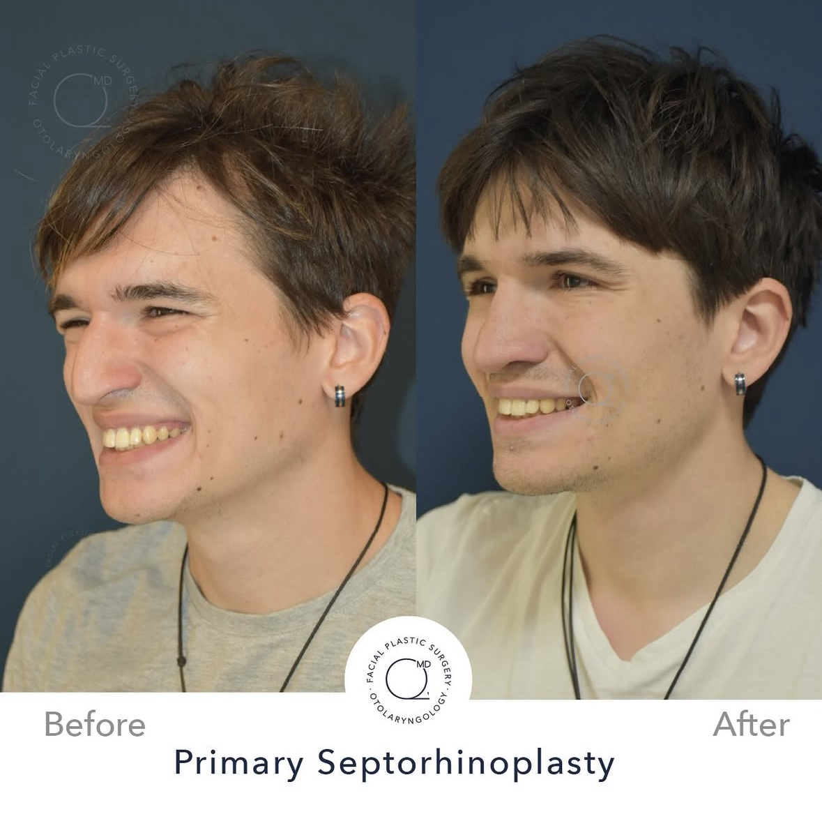 Rinoplastia masculina — fotografía interna 5