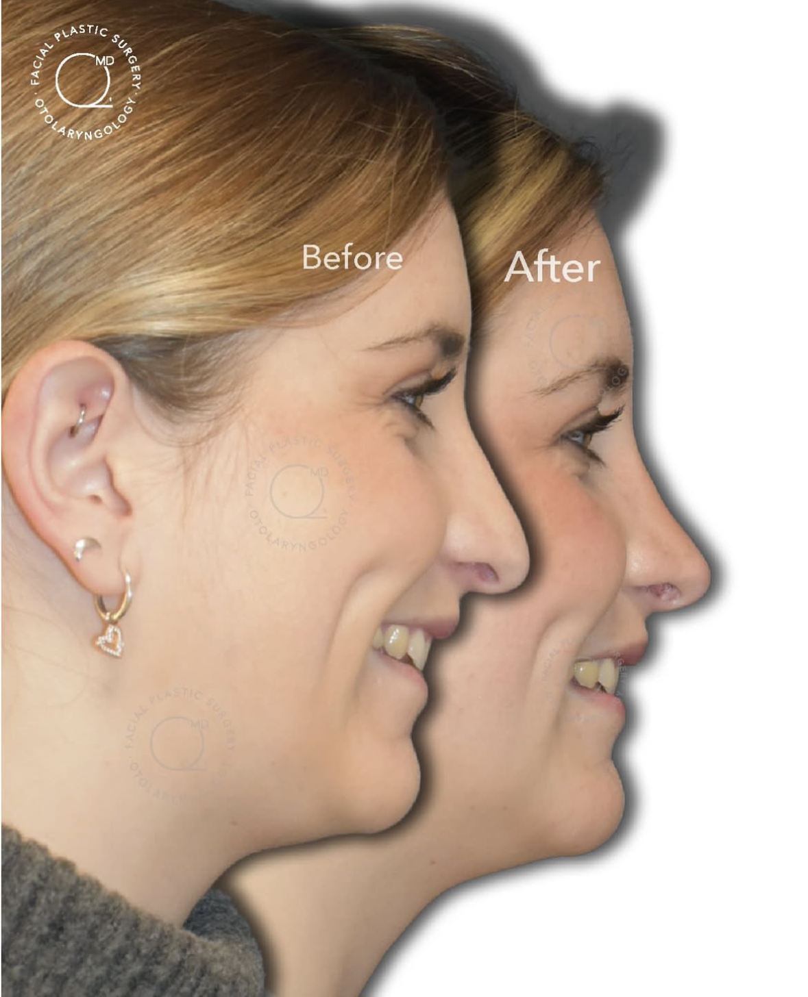 Rinoplastia femenina — fotografía interna 1