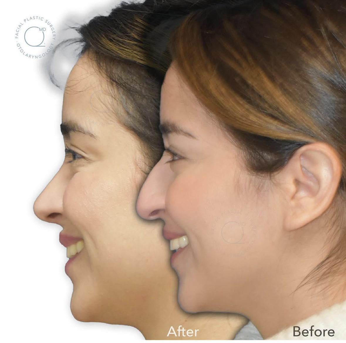 Rinoplastia femenina antes y después