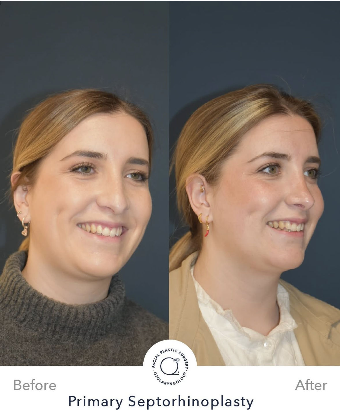Rinoplastia femenina — fotografía interna 6