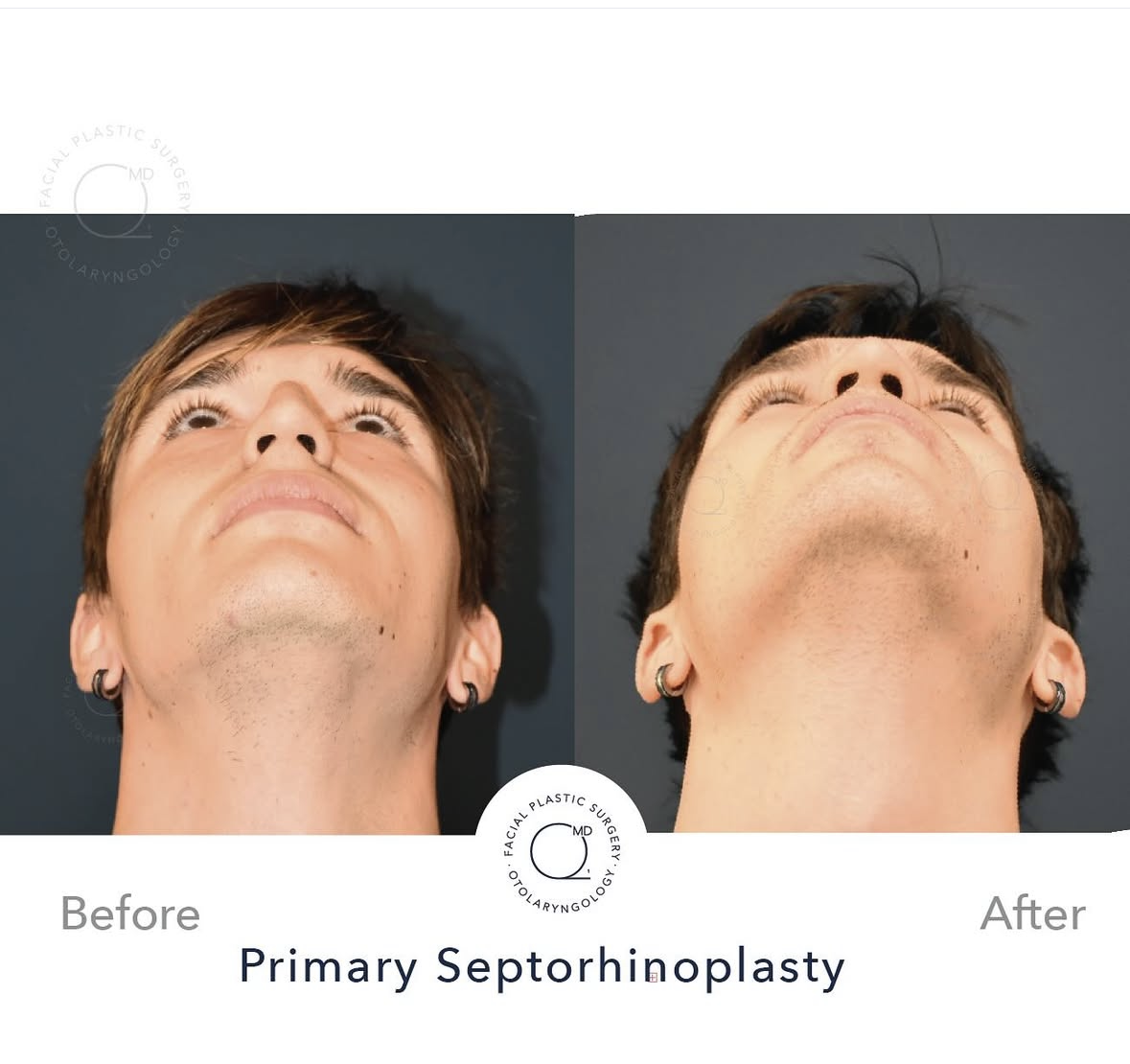 Rinoplastia masculina — fotografía interna 6