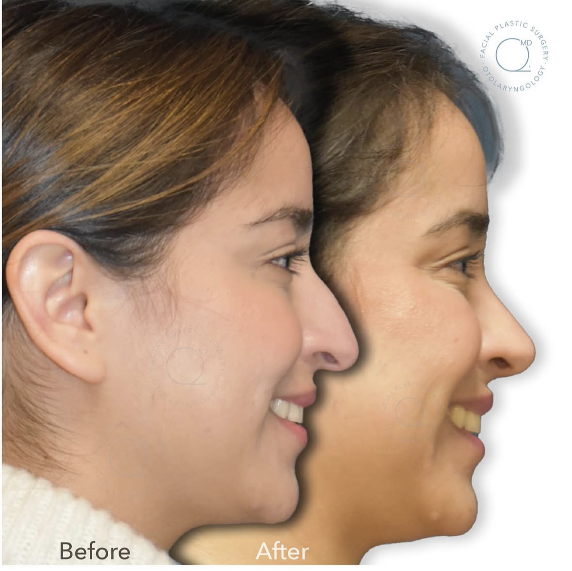 Rinoplastia femenina — fotografía interna 1
