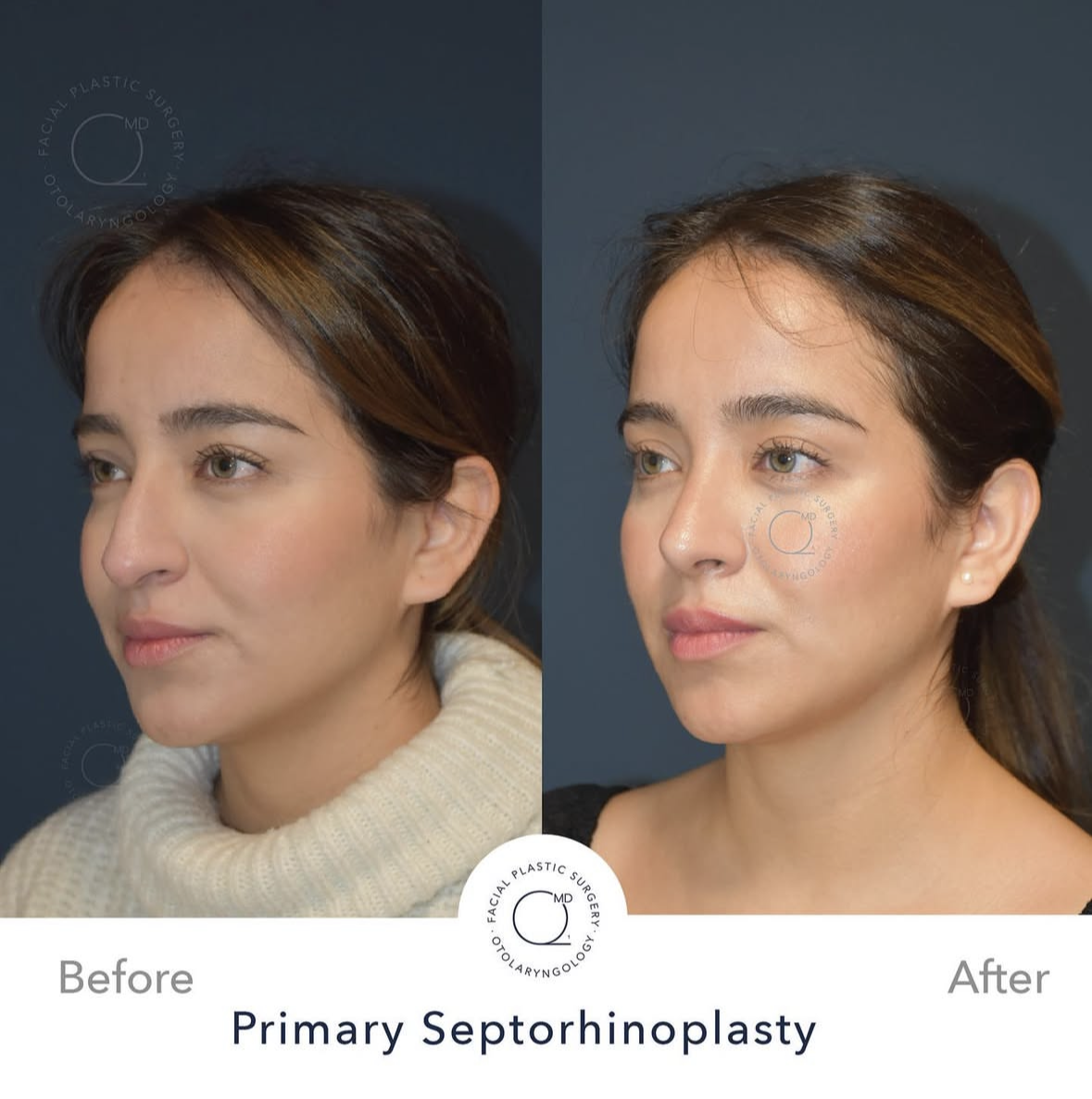 Rinoplastia femenina — fotografía interna 3