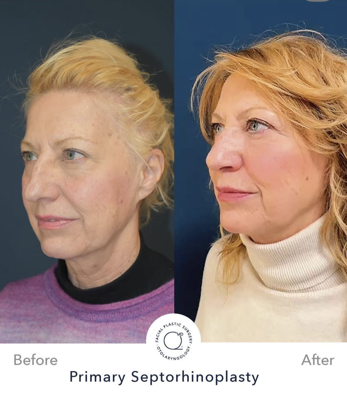 Rinoplastia femenina — fotografía interna 5