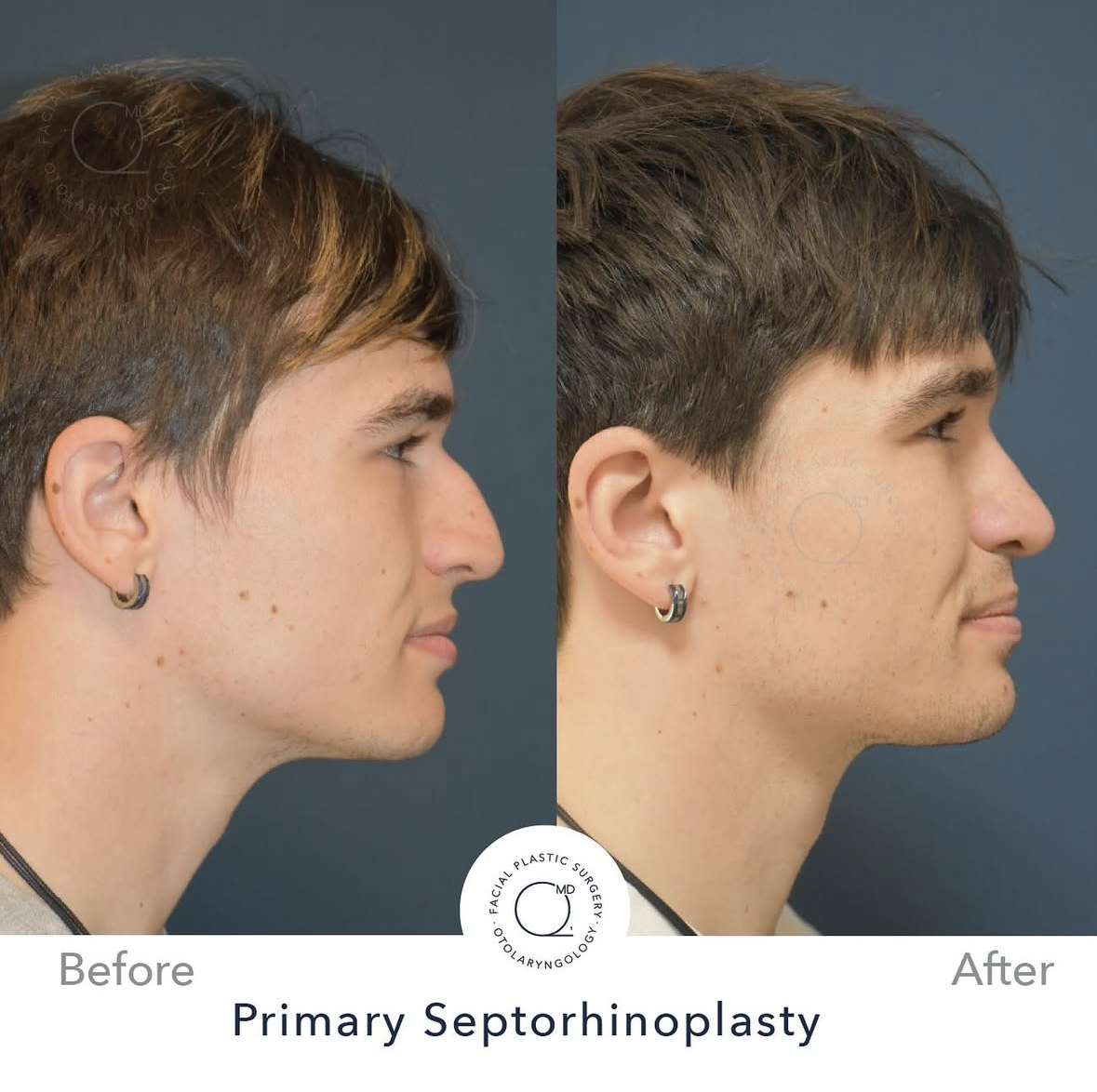 Rinoplastia masculina — fotografía interna 3