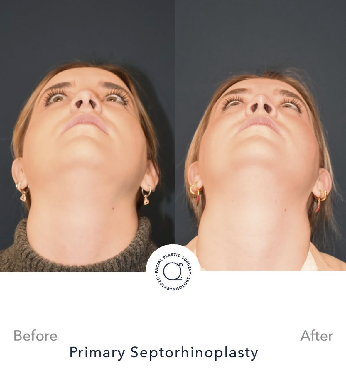 Rinoplastia femenina — fotografía interna 8