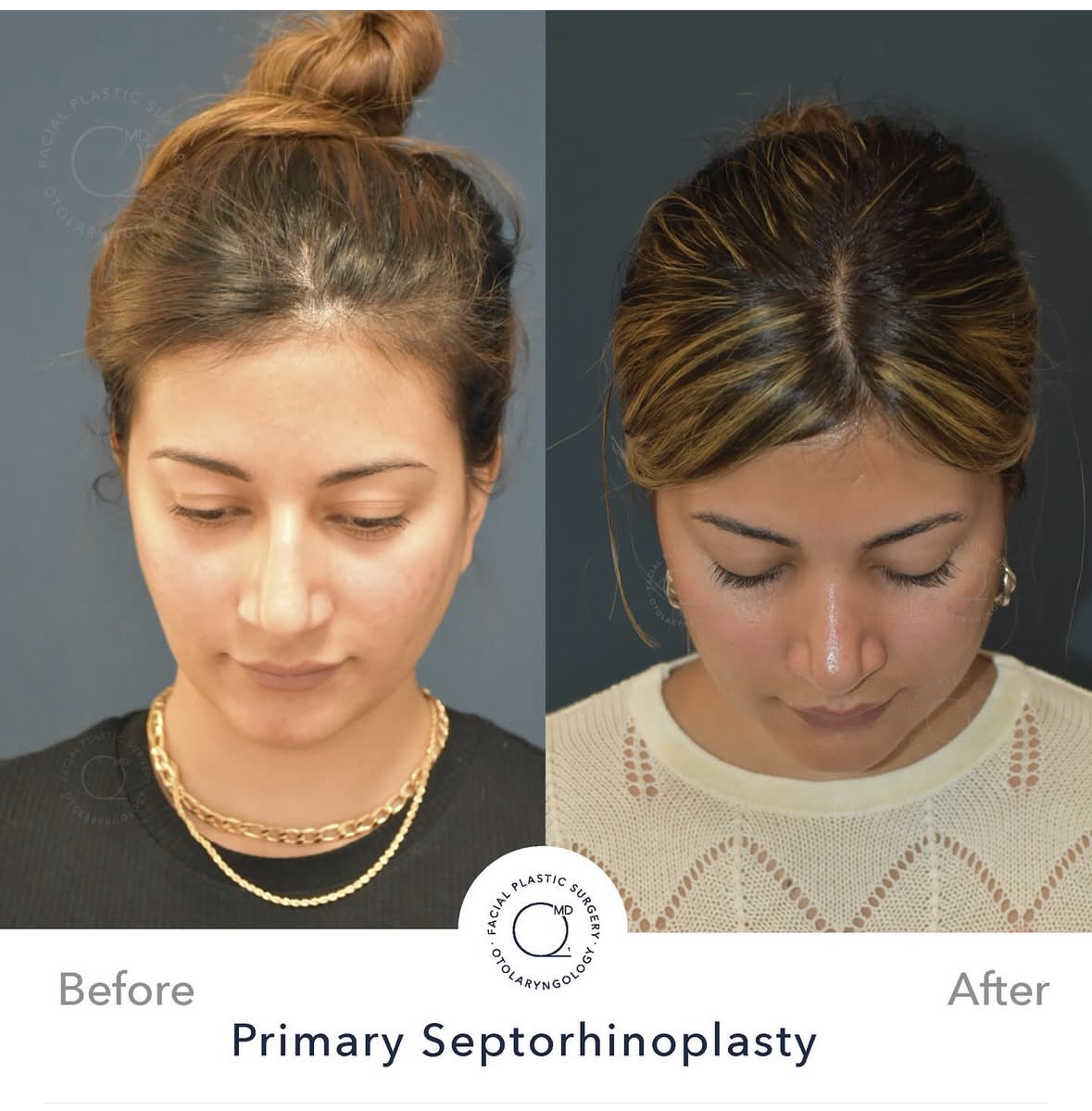 Rinoplastia femenina — fotografía 4/10