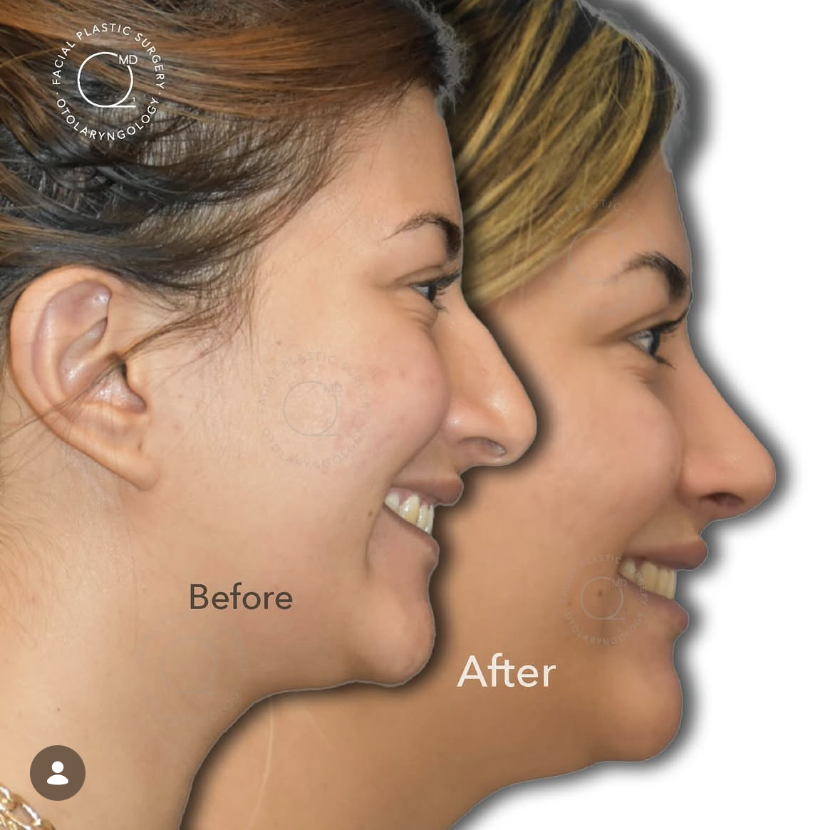 Rinoplastia femenina antes y después