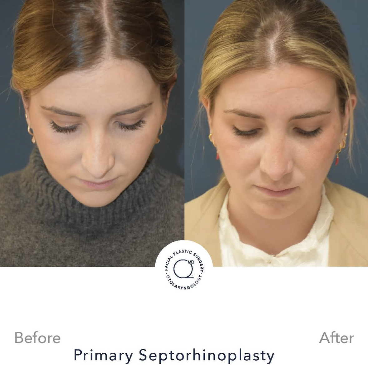 Rinoplastia femenina — fotografía interna 9