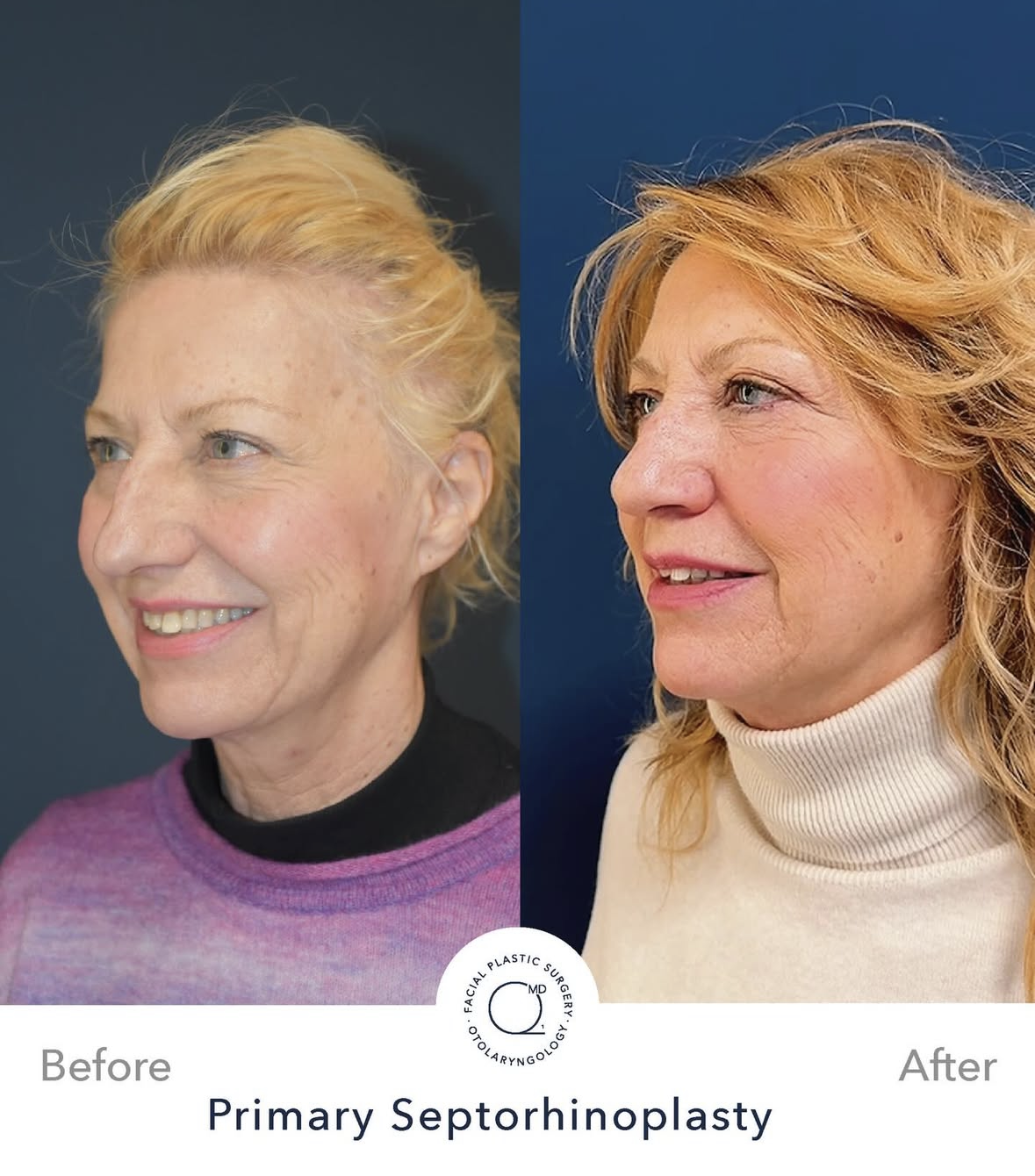 Rinoplastia femenina — fotografía interna 1