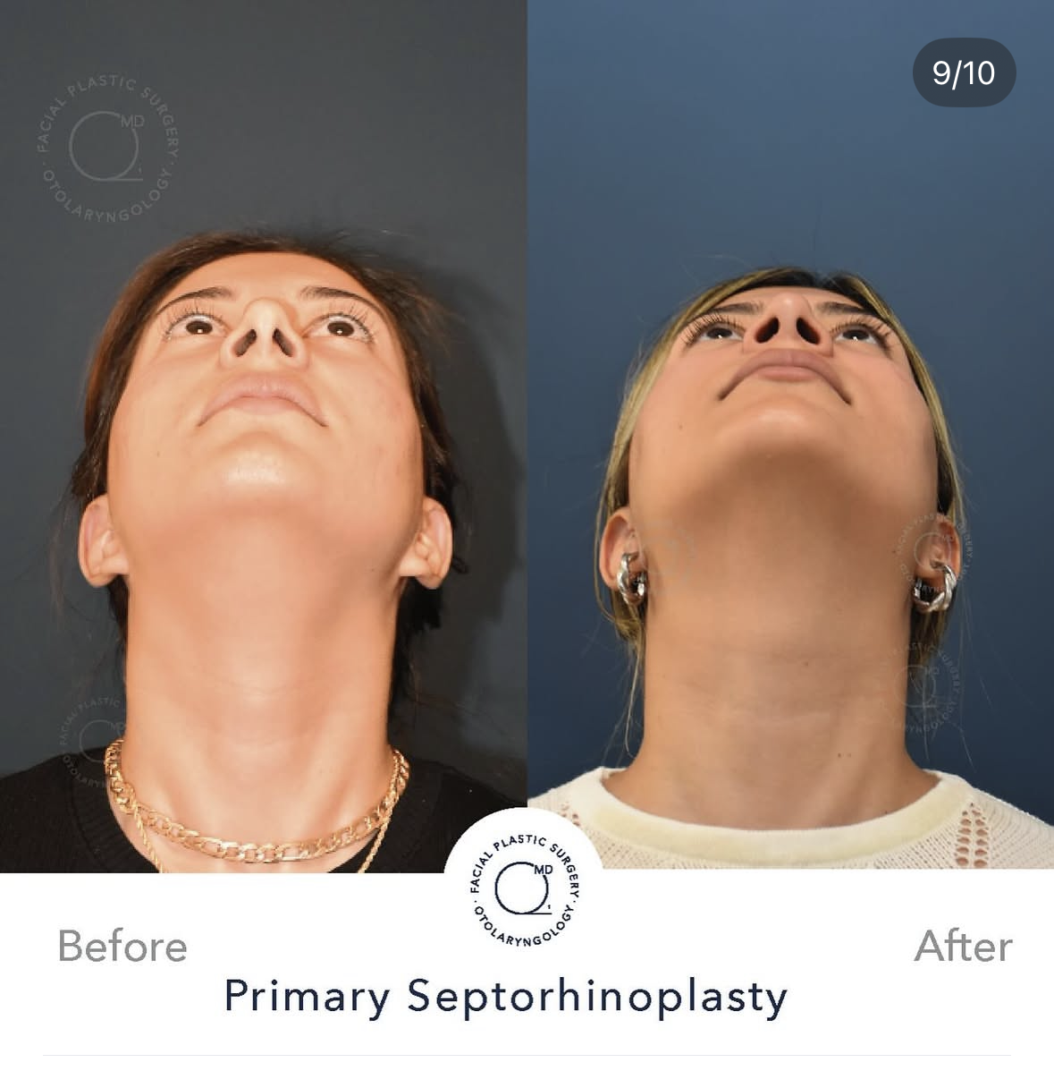 Rinoplastia femenina — fotografía 9/10