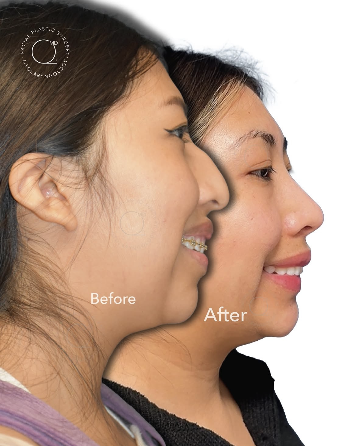 Rinoplastia femenina antes y después