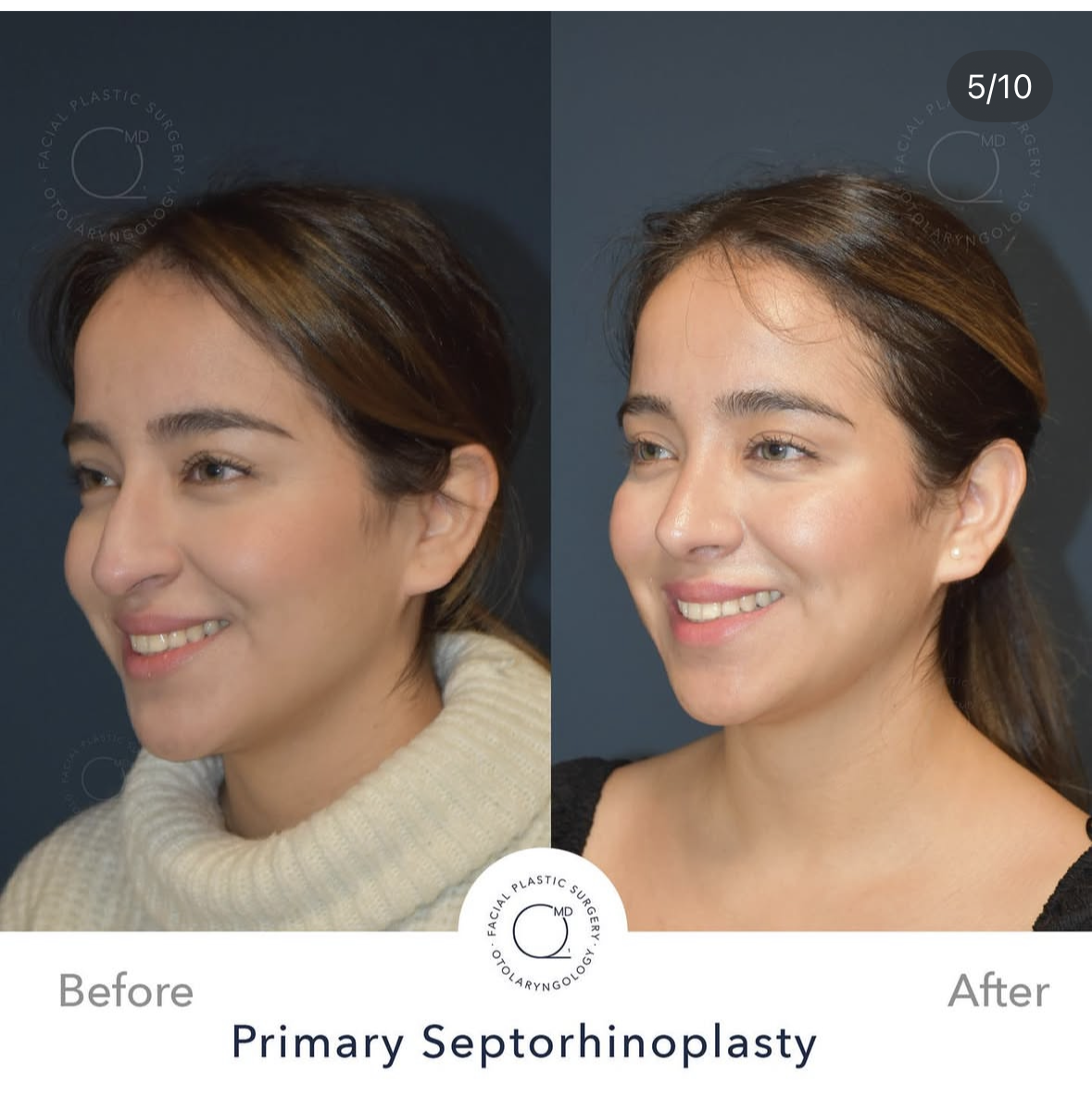 Rinoplastia femenina — fotografía 5/10