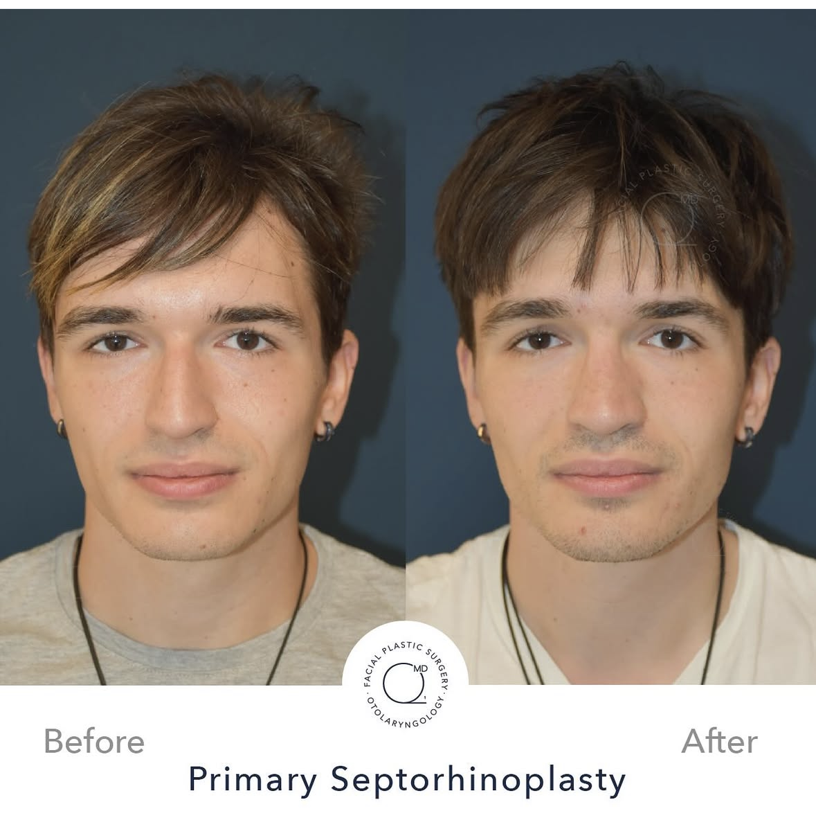 Rinoplastia masculina — fotografía interna 8