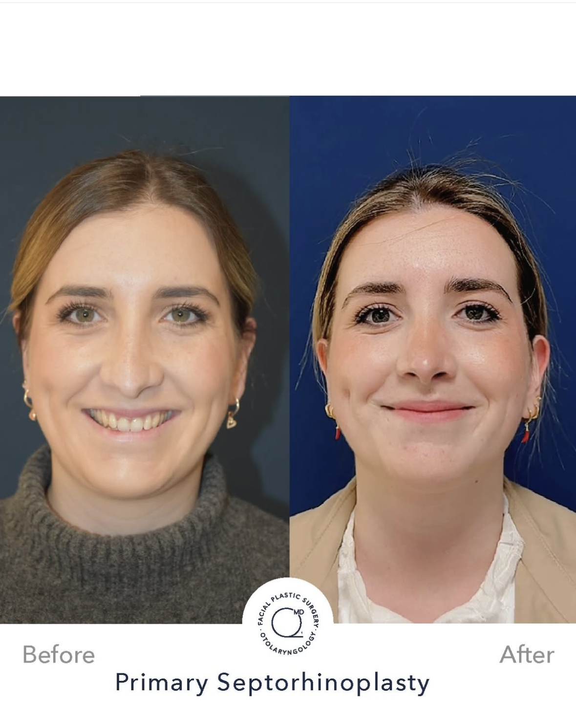 Rinoplastia femenina — fotografía interna 2