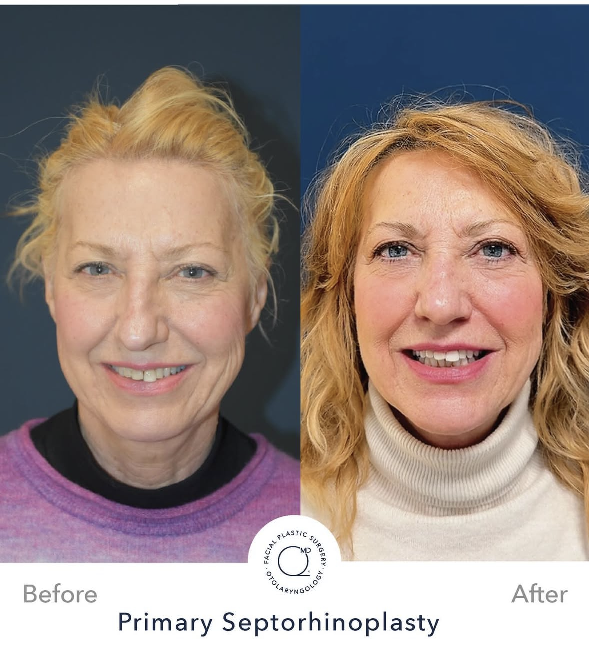 Rinoplastia femenina — fotografía interna 7