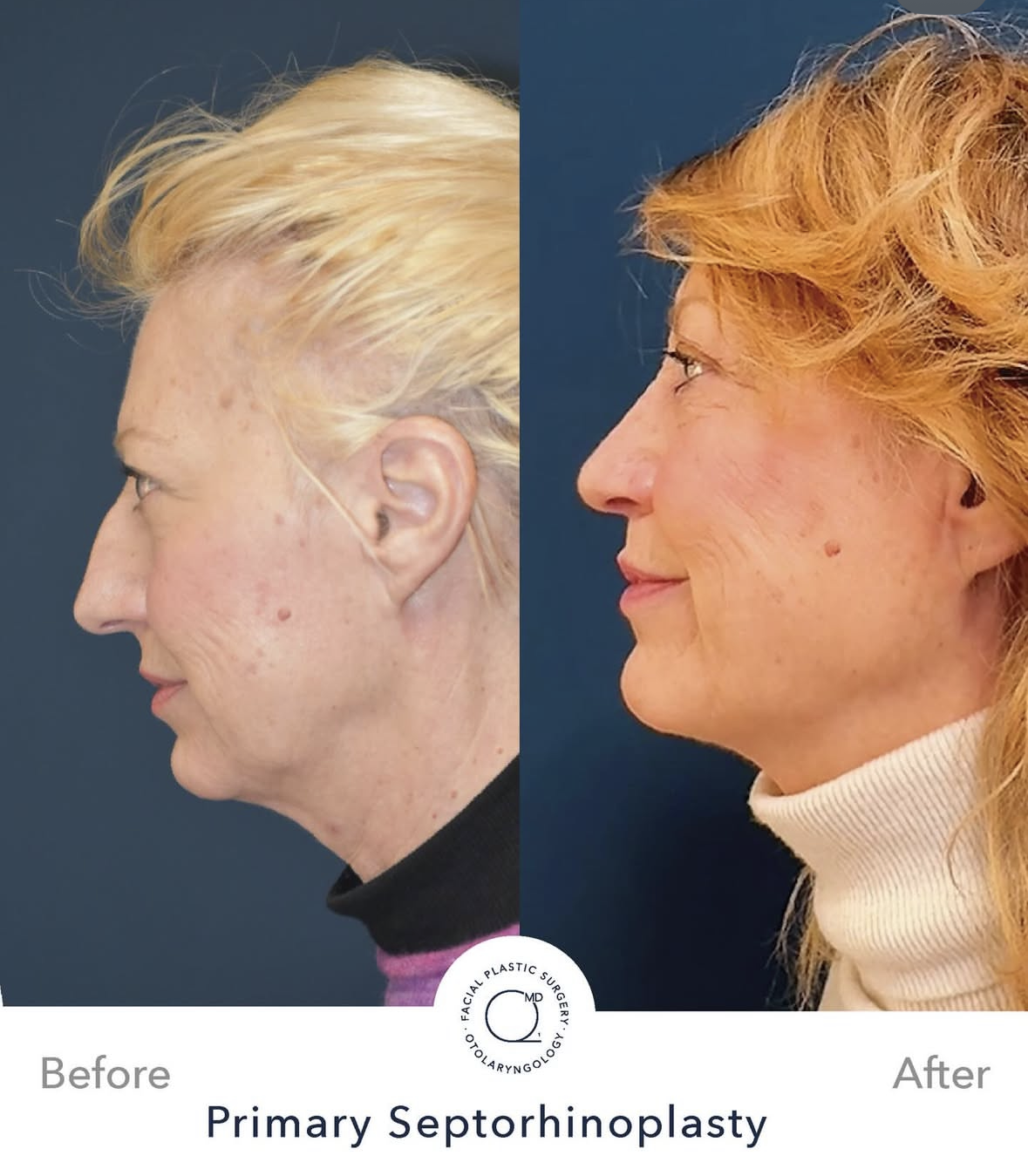 Rinoplastia femenina — fotografía interna 2