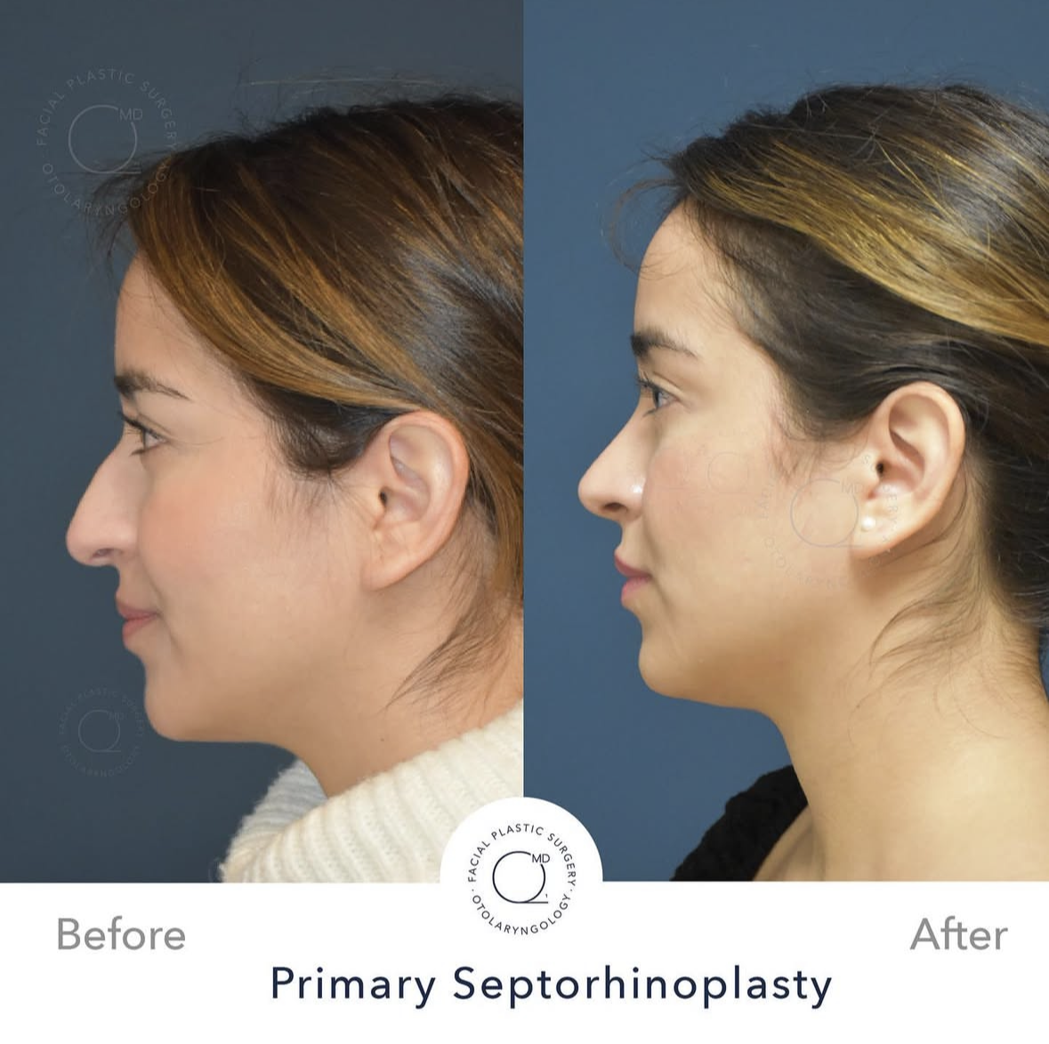 Rinoplastia femenina — fotografía interna 8