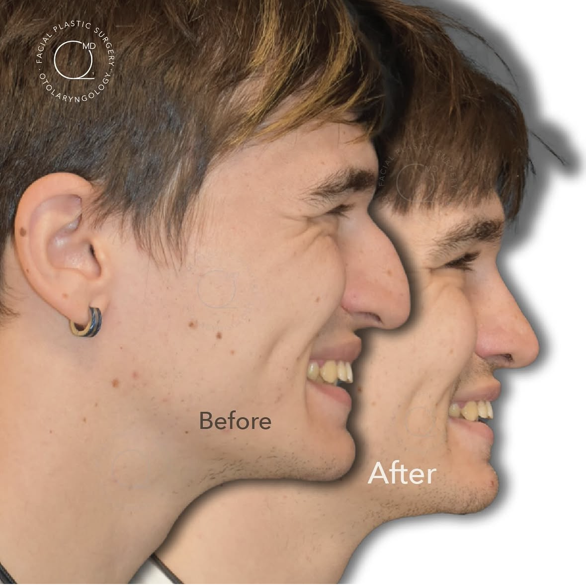 Rinoplastia masculina antes y después