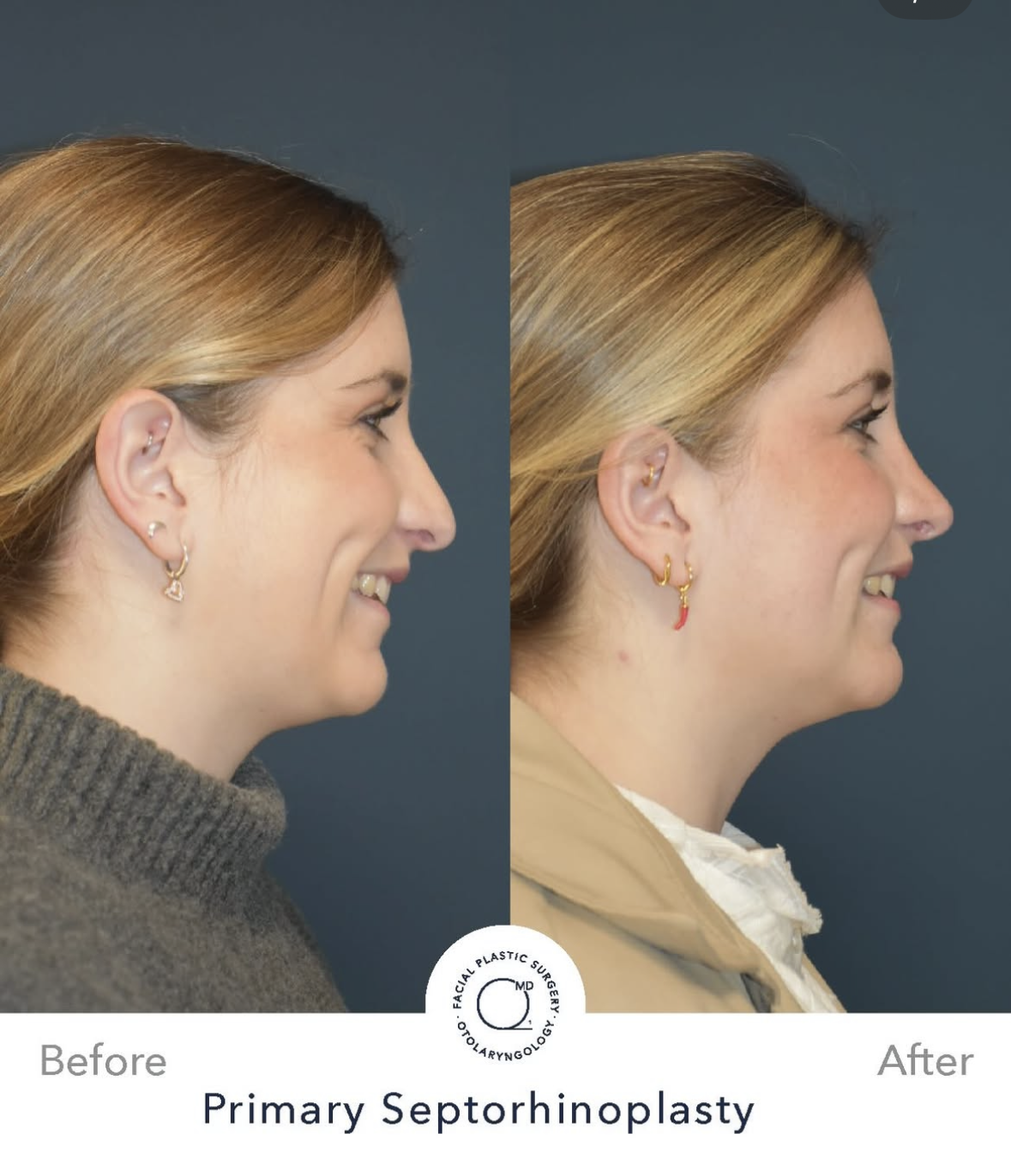 Rinoplastia femenina — fotografía interna 5