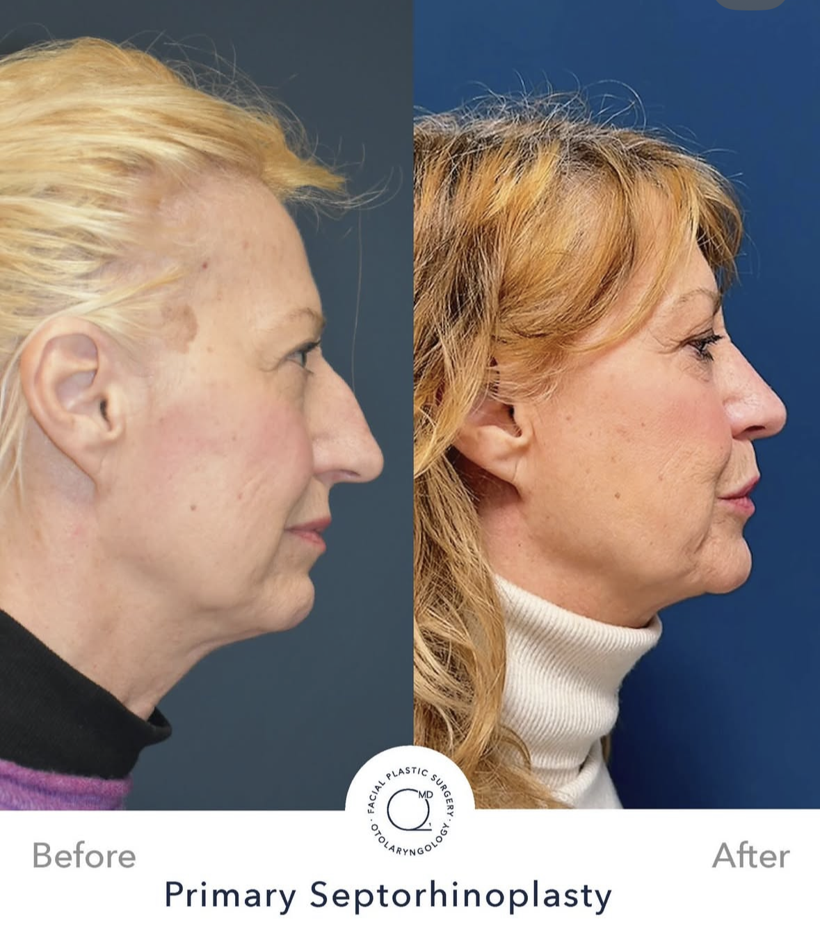 Rinoplastia femenina — fotografía interna 3