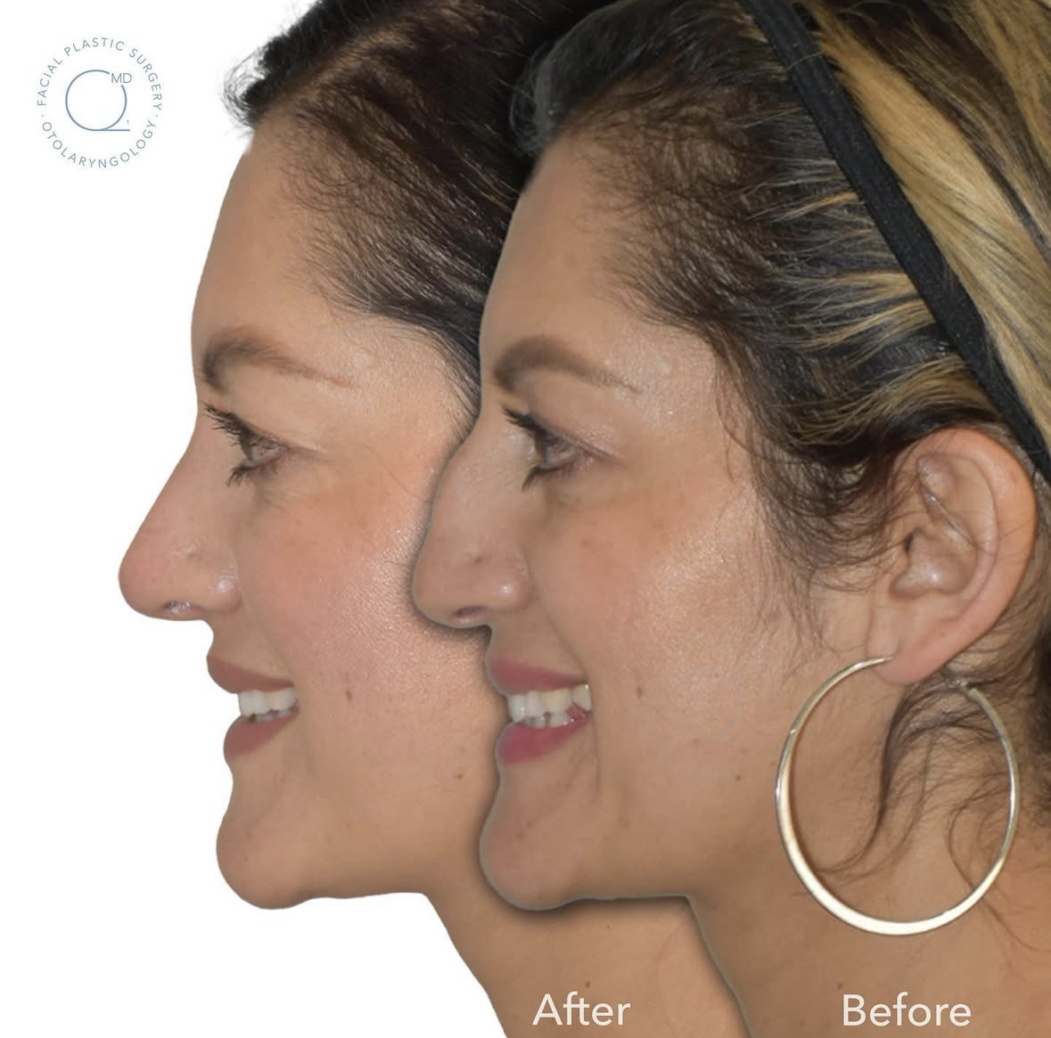 Rinoplastia Madrid caso 1 fotografía 8