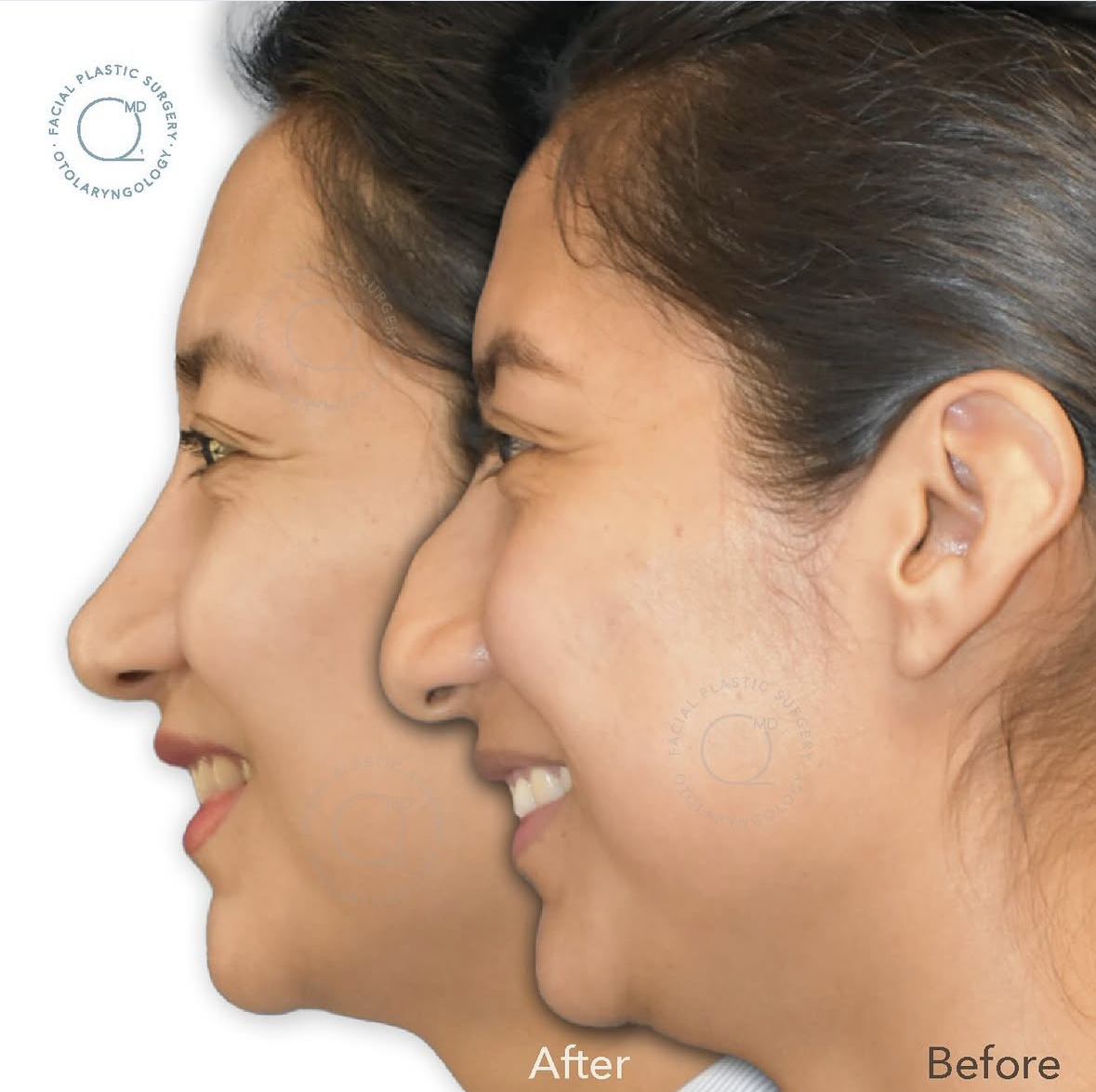 Rinoplastia femenina antes y después
