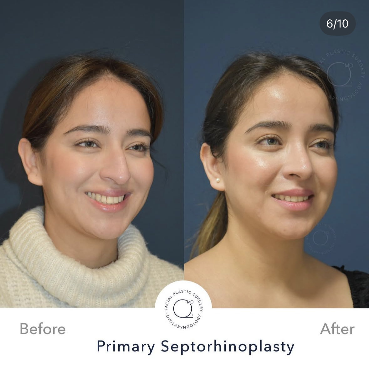 Rinoplastia femenina — fotografía 6/10
