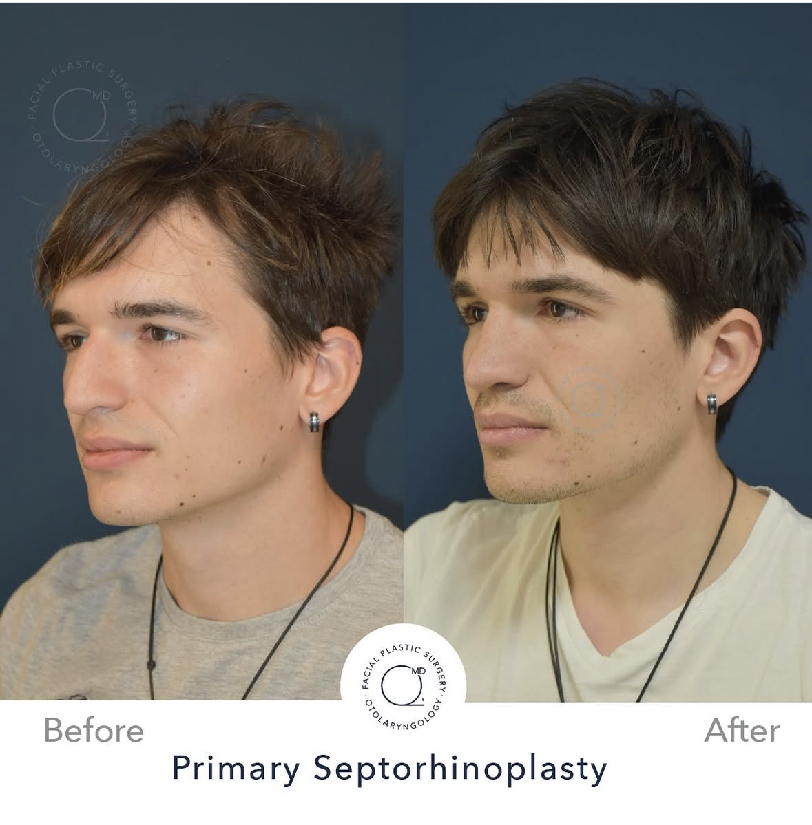 Rinoplastia masculina — fotografía interna 4