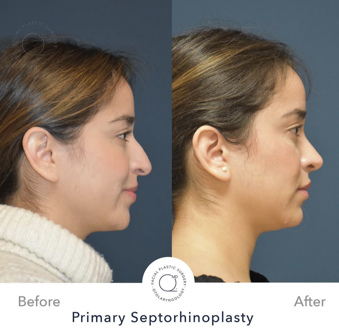 Rinoplastia femenina — fotografía interna 7