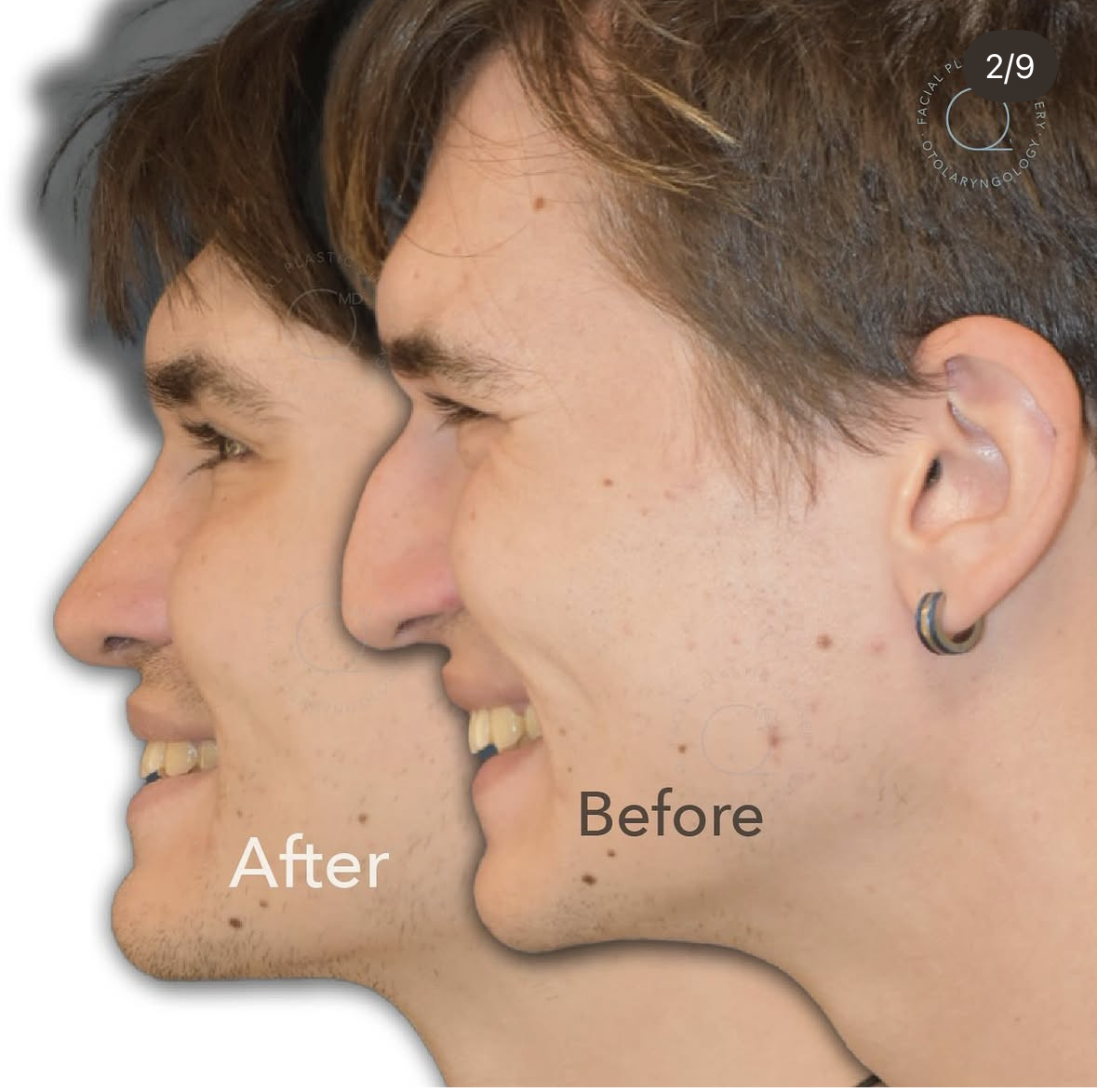 Rinoplastia masculina — fotografía interna 1