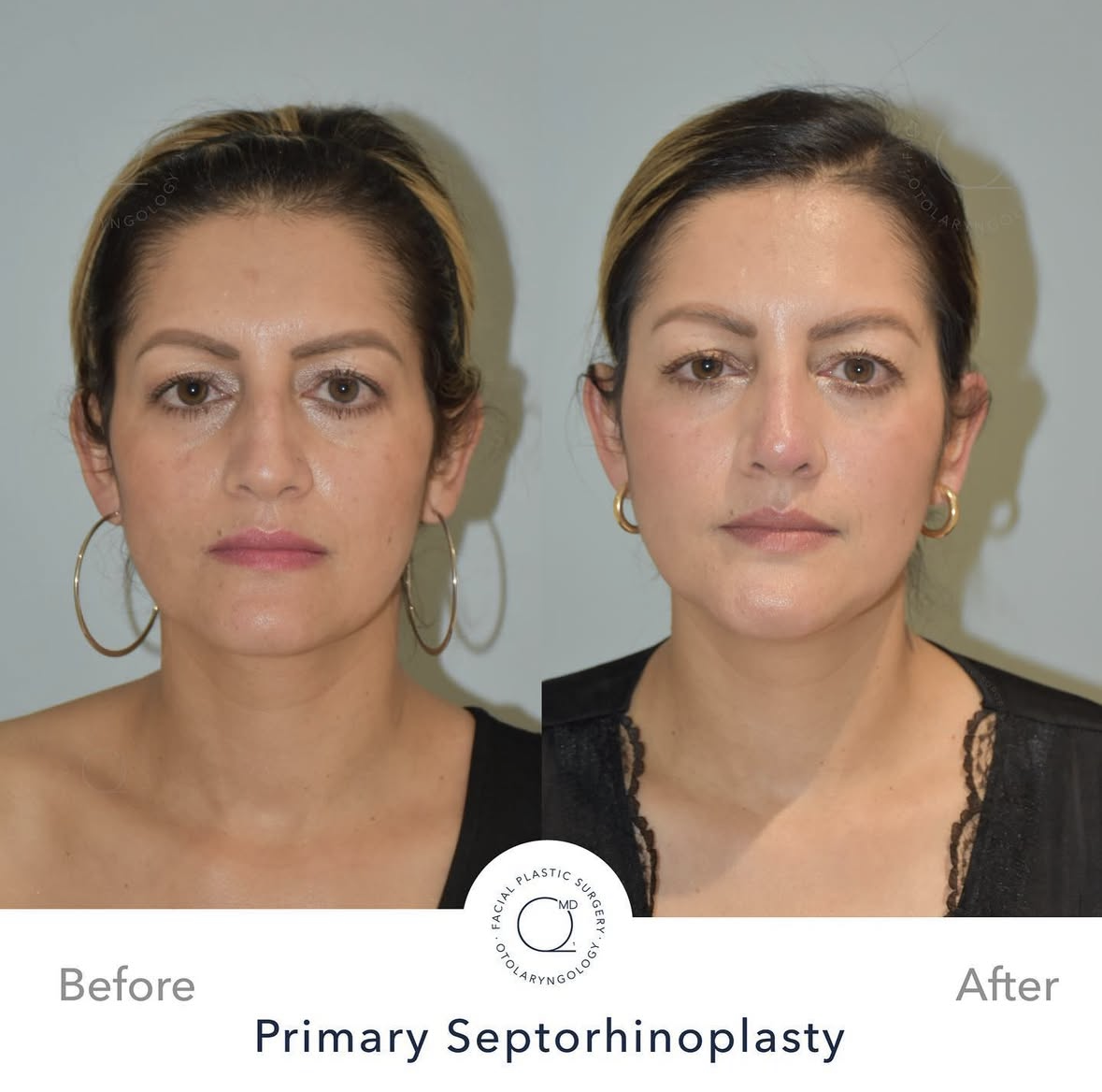 Rinoplastia Madrid caso 1 fotografía 6