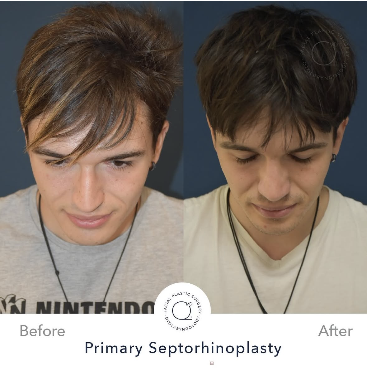 Rinoplastia masculina — fotografía interna 7