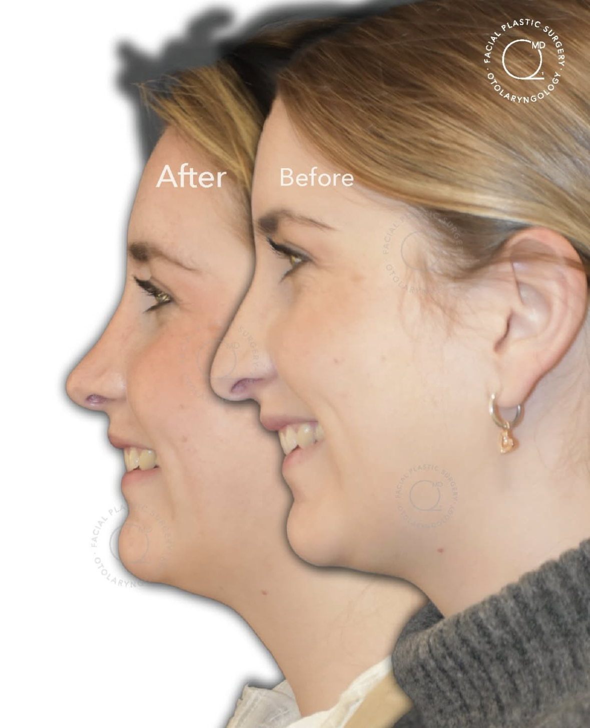 Rinoplastia femenina antes y después