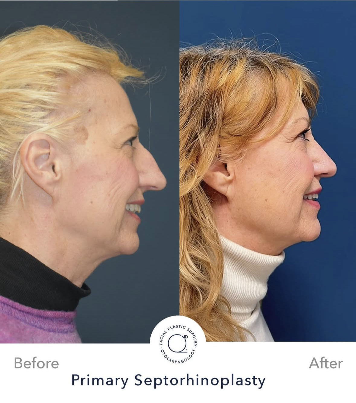 Rinoplastia femenina — fotografía interna 6