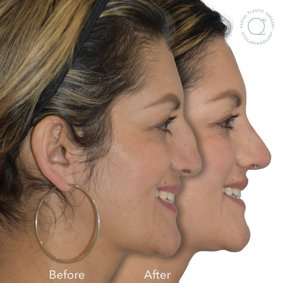 Rinoplastia Madrid caso 1 fotografía 7
