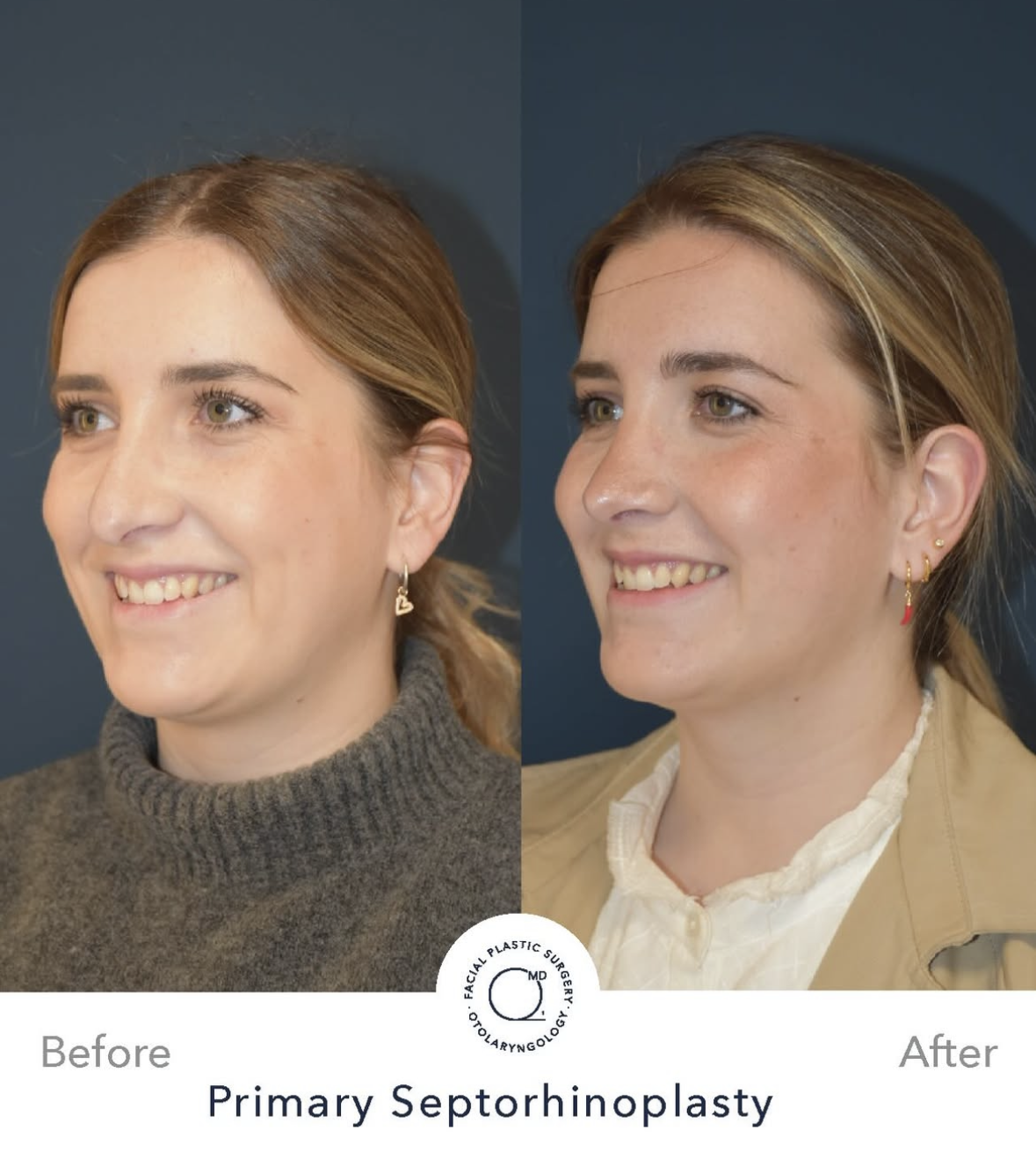 Rinoplastia femenina — fotografía interna 7