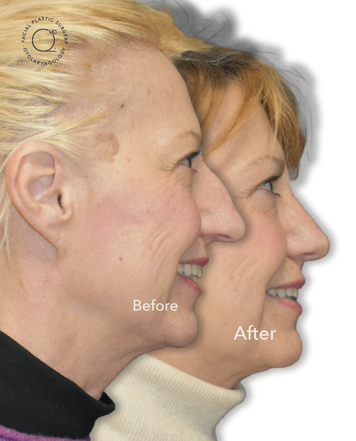 Rinoplastia femenina antes y después