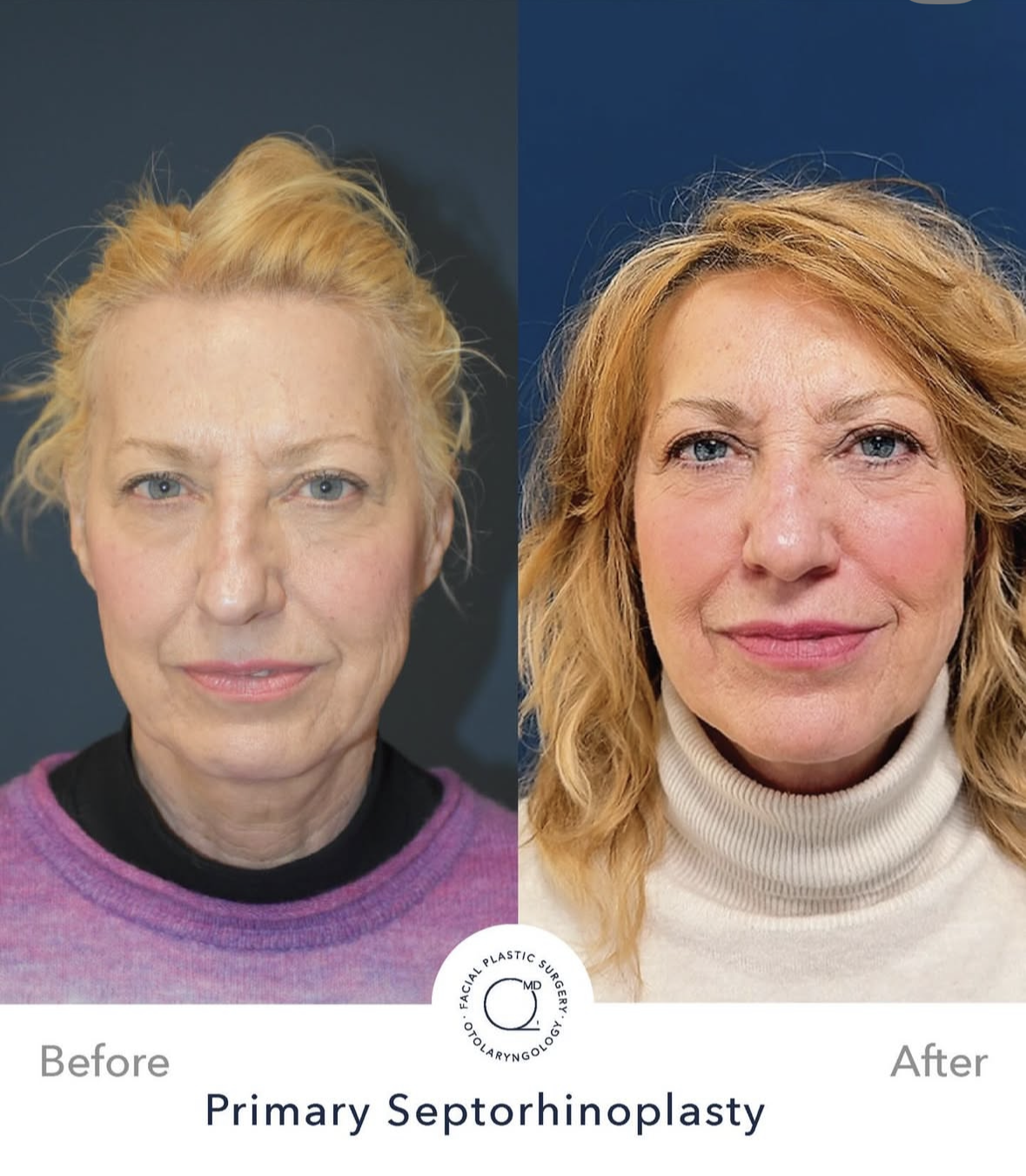 Rinoplastia femenina — fotografía interna 4