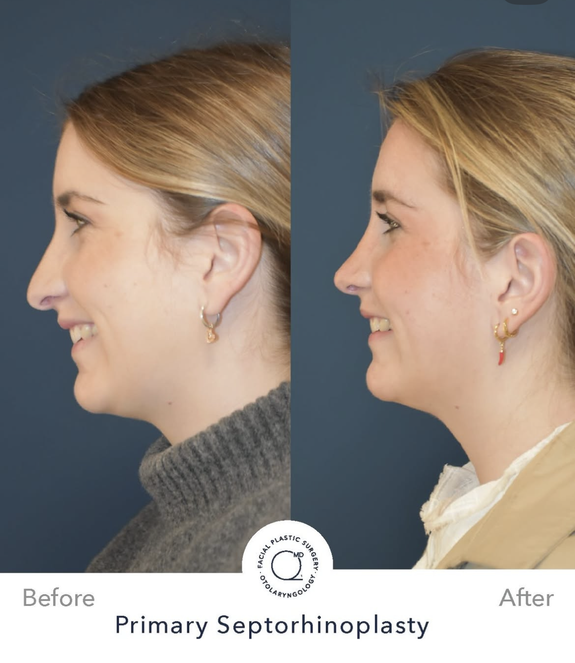 Rinoplastia femenina — fotografía interna 4