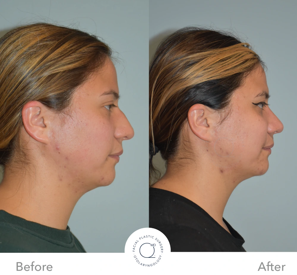 Antes y después de perfil complementario en rinoplastia revisional