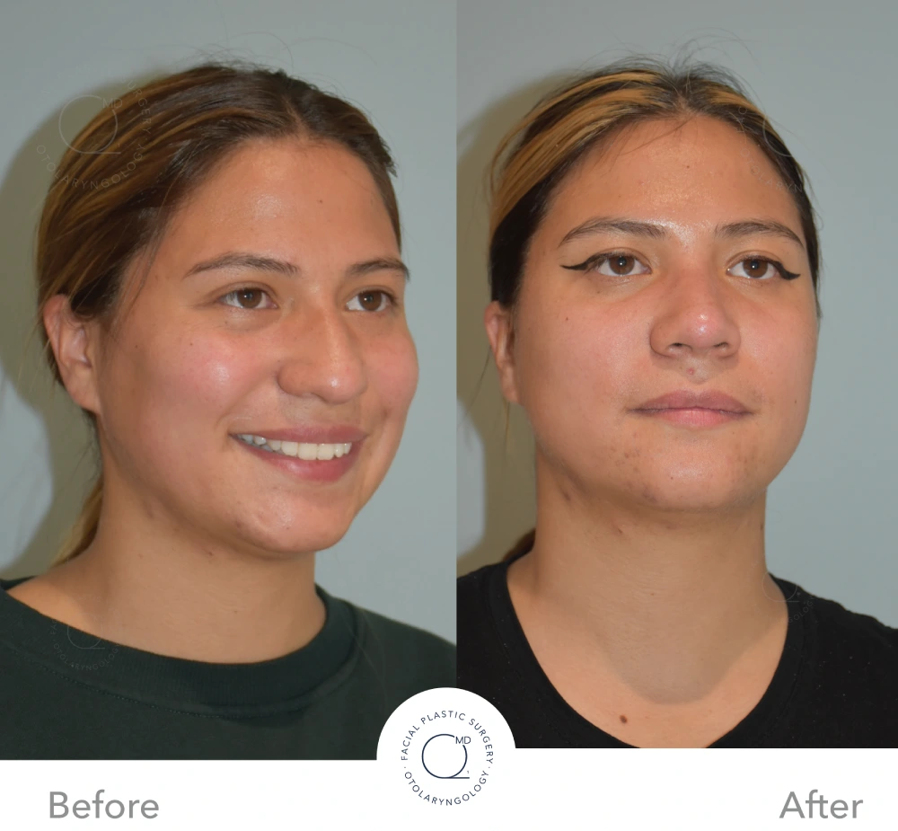 Antes y después en vista frontal de rinoplastia revisional