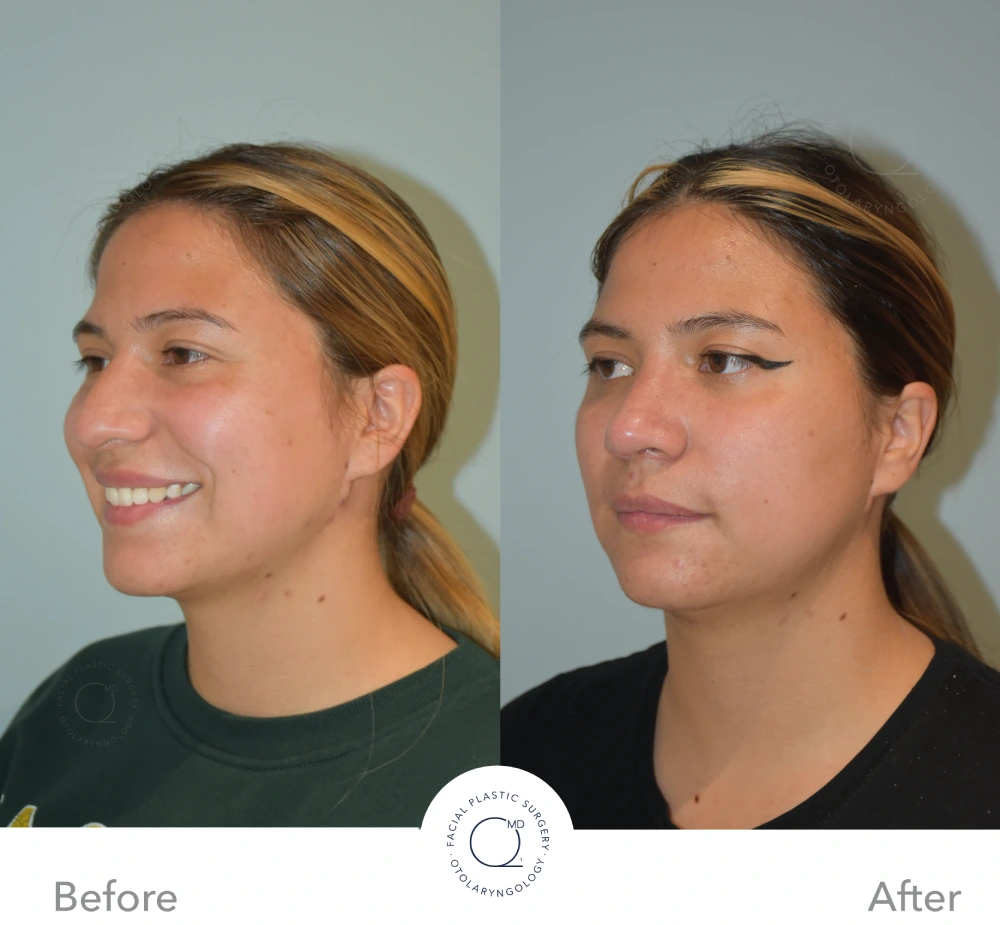 Antes y después en vista oblicua de rinoplastia revisional