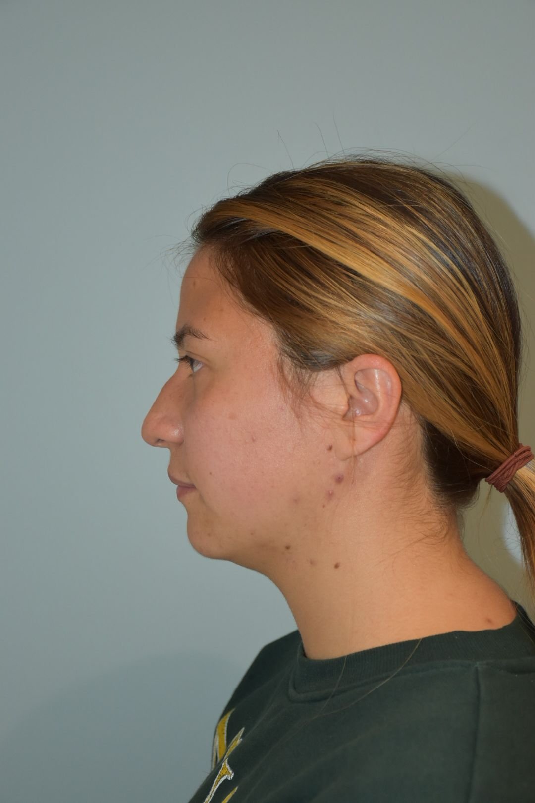 Fotografía clínica preoperatoria de perfil