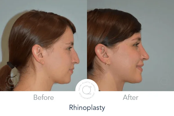 Caso 13: rinoplastia secundaria reconstructiva antes y después